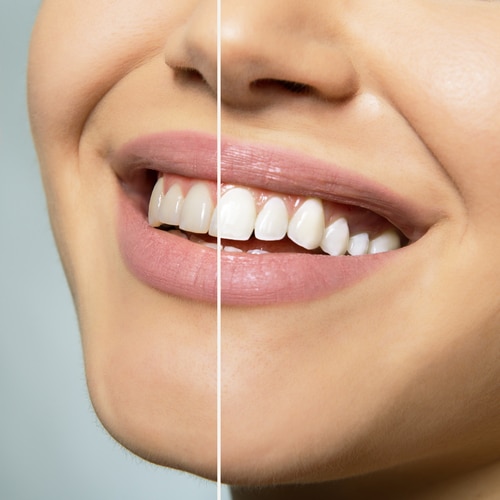 Teeth Bleaching in Schaumburg, IL | Brighten Your Smile Today!