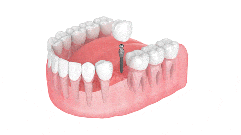 Mini Dental Implants in Jasper, AL | Bivona Family Dentistry
