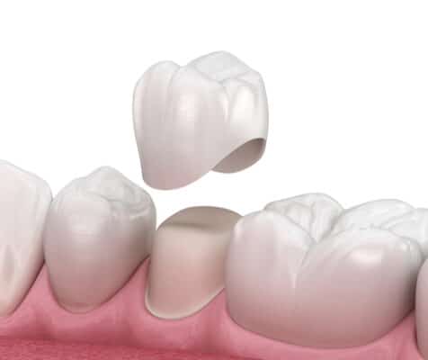 Same-Day Crowns in Jasper, AL | Bivona Family Dentistry