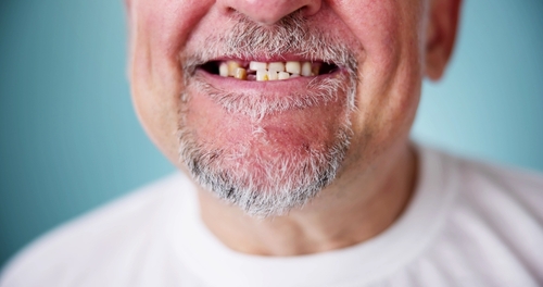 Missing Teeth in Jasper, AL | Book a Free Consultation Today