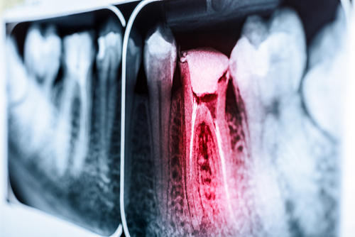 Root Canal Treatment in Jasper, AL | Experience Pain Relief Today!