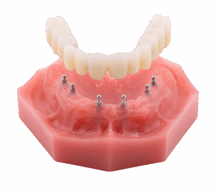 Mini Implants for Dentures in Jasper, AL | Semi-Removable Roundhouse Bridge