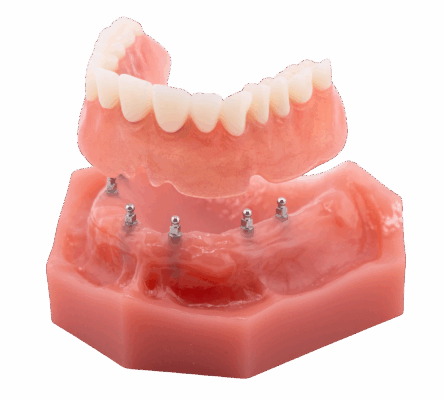 Dental Implant in Jasper, AL | Book a Free Implant Consultation