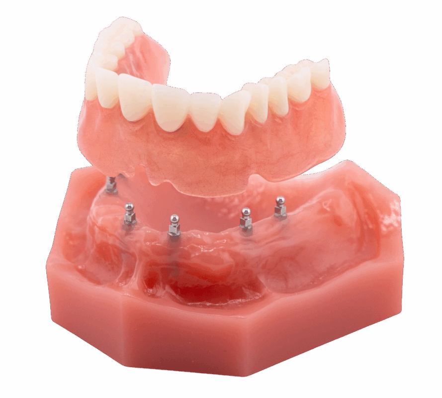 Dental Implant in Jasper, AL | Book a Free Implant Consultation