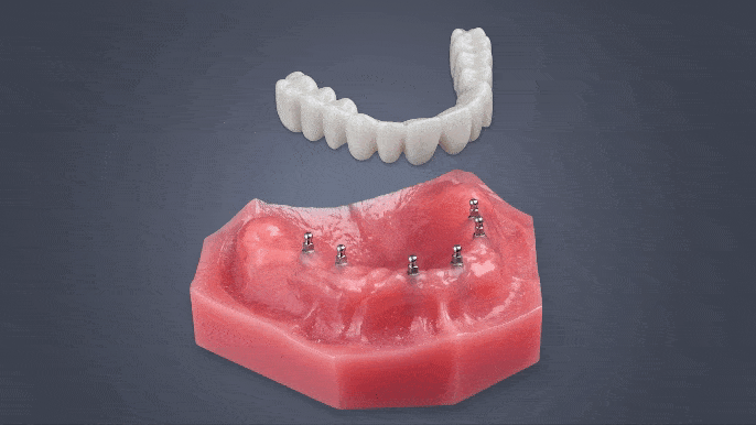 Denture Stabilization in Jasper, AL | Roundhouse Bridges