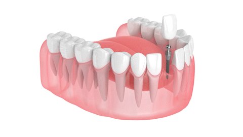 Dental Implant in Jasper, AL | Implant-Retained Crowns