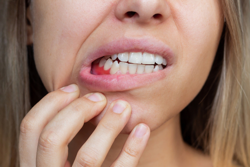 Bleeding Gums in Jasper, AL | Affordable Gum Disease Treatment