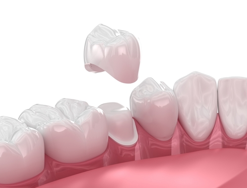 CEREC in Jasper, AL | Affordable Dental Care | Same-Day Crowns