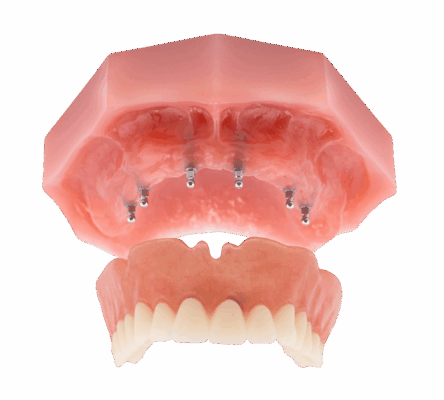 Full Mouth Dental Implants in Jasper, AL | Book a Free Consultation