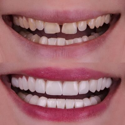 Instant Orthodontics in Jasper, AL | Revamp Your Smile With Veneers