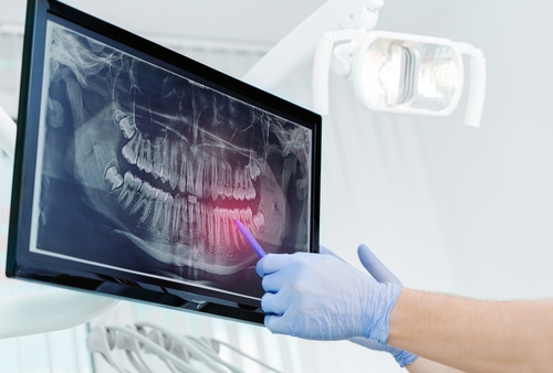 Emergency Dentistry in Jasper, AL | Affordable Dental Care