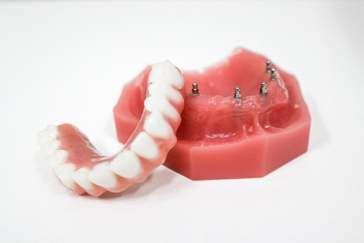 What Are the Advantages of Dental Implants Over Dentures? | Free Implant Consultations in Jasper, AL