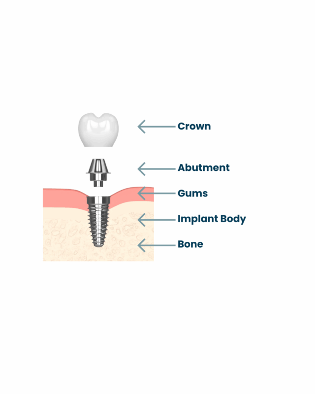 Conventional Implant in Jasper, AL | Free Implant Consultations!