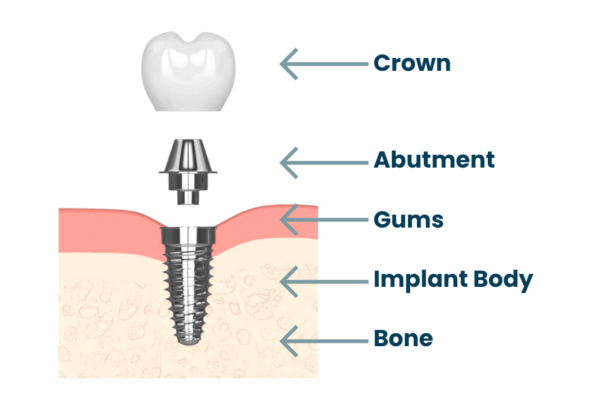 Conventional Implant in Jasper, AL | Free Implant Consultations!