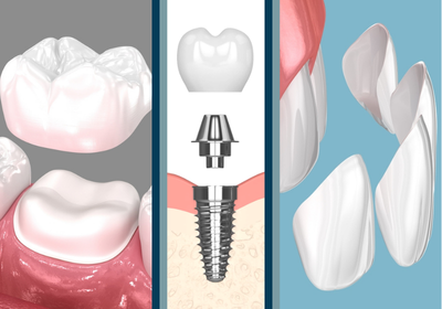 Veneers vs Crowns vs Implants | Find Affordable Care in Jasper, AL
