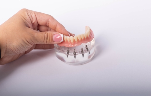 The Implant Denture Process in Jasper, AL [Video Q&A]