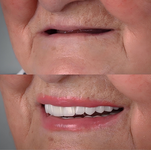 All-on-4 in Jasper, AL | Free Implant Consultations [Video Inside]