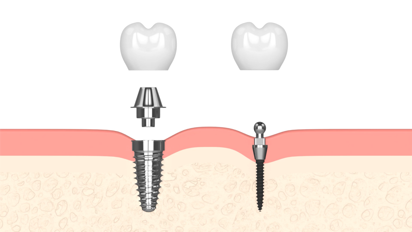 Best Implant Options in 2026 [Video Breakdown] | Jasper, AL