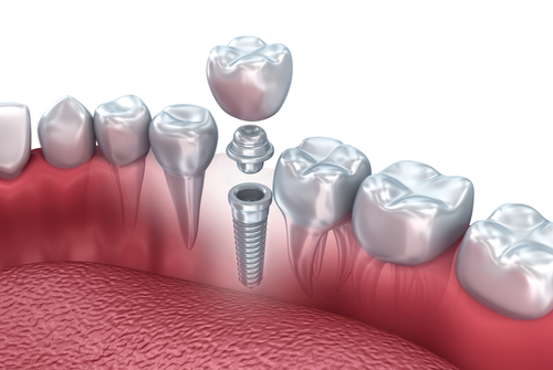 One-Piece Dental Implants in Jasper AL | Simplify Your Implant Procedure