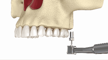Sinus Bump in Jasper, AL | Indirect Sinus Lift for Dental Implants