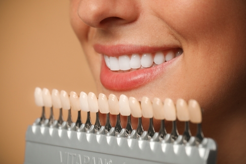 Veneers Financing [A Video Q&A] | Revamp Your Smile Affordably!