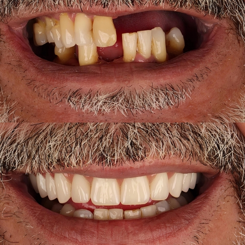 Full Mouth Reconstruction [Video FAQs] | Dental Care in Jasper, AL