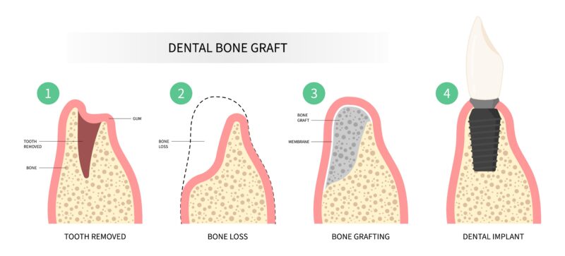 Not Enough Bone for Implants in Jasper, AL | Bone Grafting Rebuilds Lost Bone