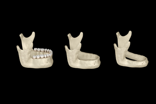 Not Enough Bone for Implants in Jasper, AL | Book a Free Implant Consult