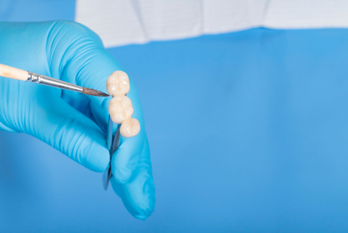 Implant Bridge [Video Guide] | Free Implant Consultations in Jasper