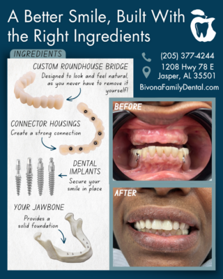 Roundhouse Bridge in Jasper, AL | Restore Your Smile With Dental Implants