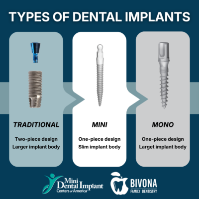 Types of Dental Implants in Jasper, AL | Book a Free Implant Consultation