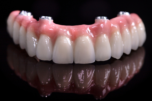 How Many Implants Are Needed for Upper Denture? [Video Q&A]