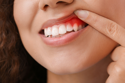 Reverse Gum Disease [Video Explanation] | Oral Health Tips in AL
