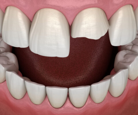 Broken Tooth in Jasper, AL | Emergency Dental Care Near Me