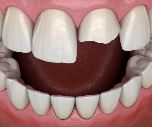 Broken Tooth in Jasper, AL | Emergency Dental Care Near Me